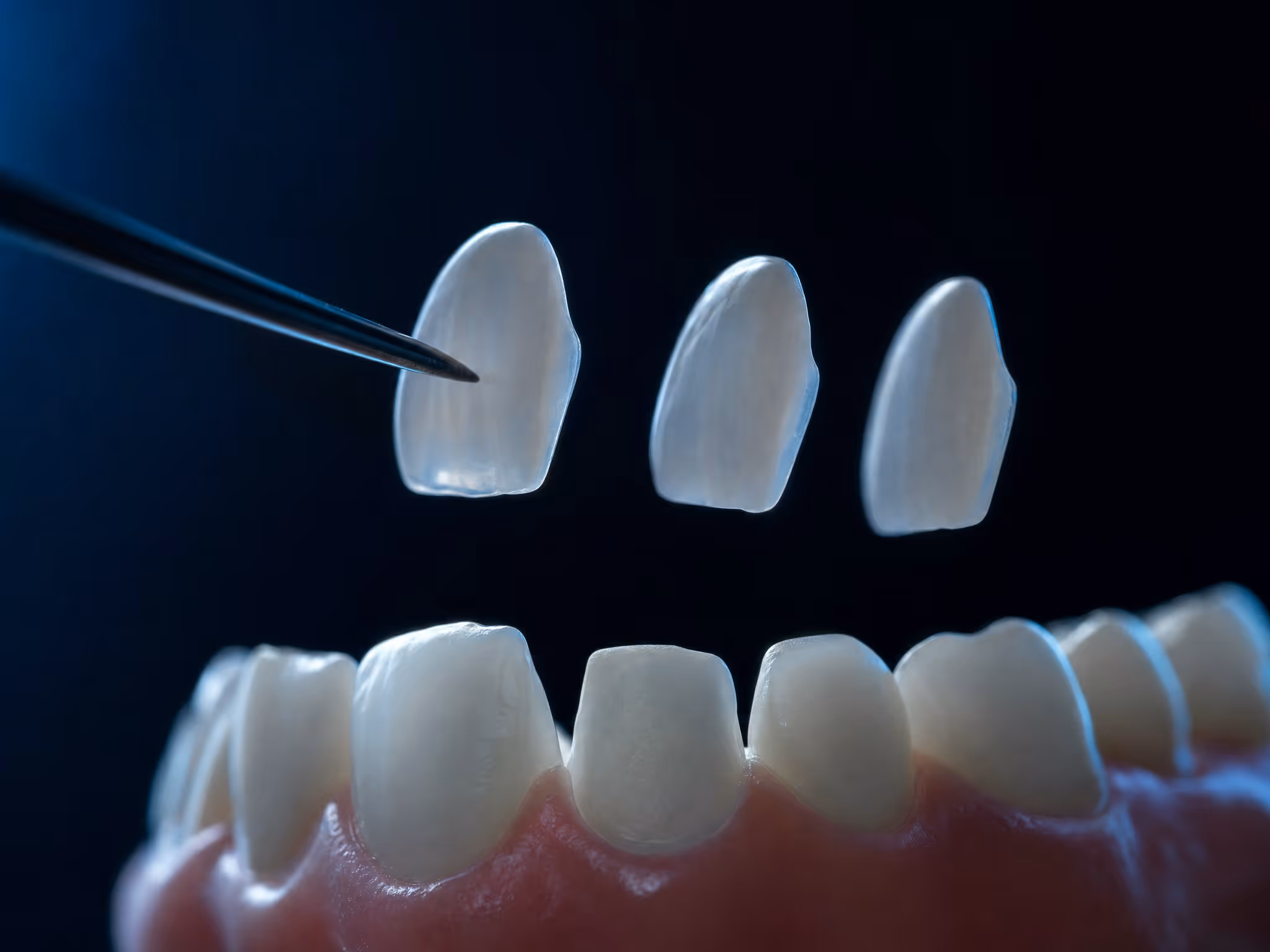 Lentes de cerâmica ultrafinas sendo posicionadas sobre os dentes da frente
