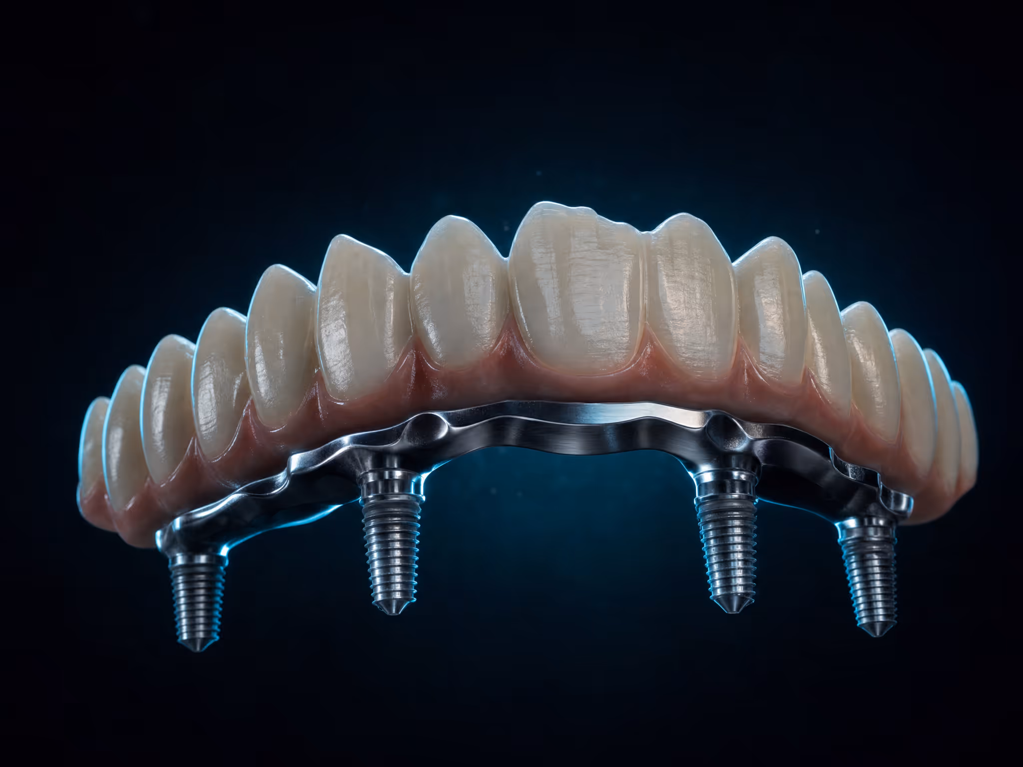 Prótese fixa de arcada completa apoiada sobre quatro implantes de titânio